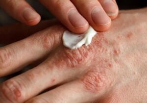 تغییر فصل، محرک اگزماست