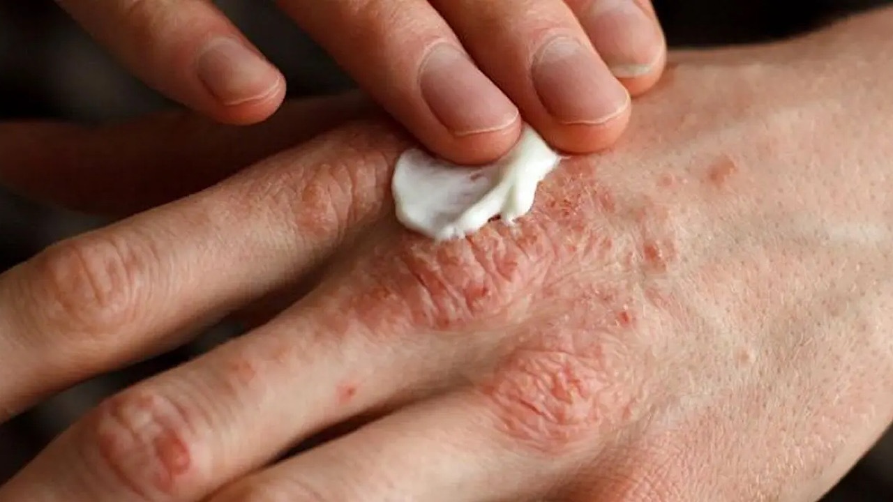 تغییر فصل، محرک اگزماست