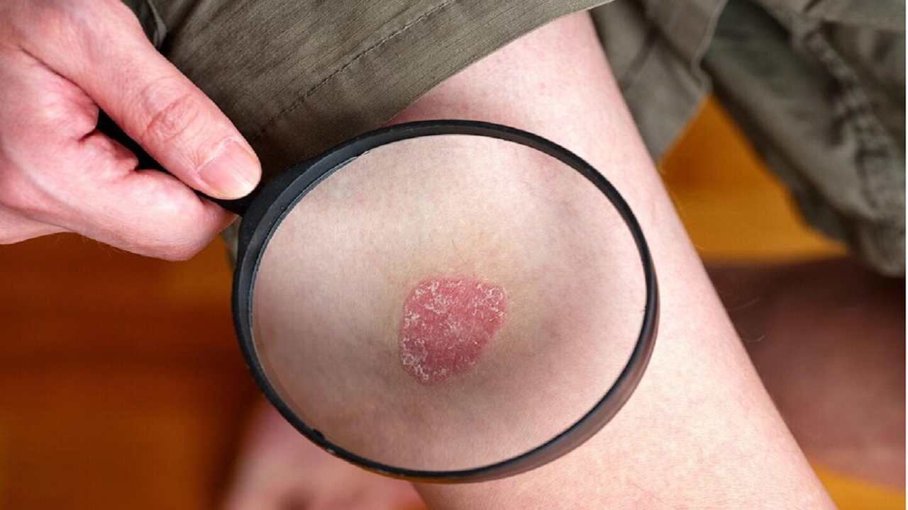 کشف روش کاهش علائم پسوریازیس